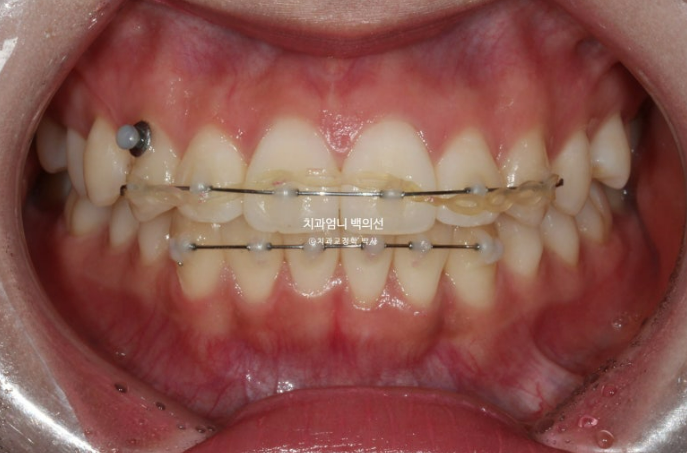 앞니 부분 교정 토끼이빨 덧니교정 ? 관련 이미지 7