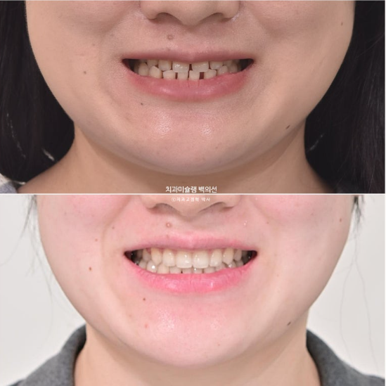 앞니 벌어짐 합죽이 방지 교정 기간 1년 4개월 관련 이미지 15
