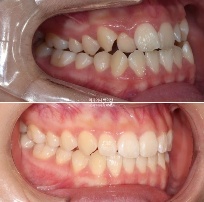 중학생 주걱턱 반대교합 개방교합 덧니 교정 인비절라인 후기 관련 이미지 11