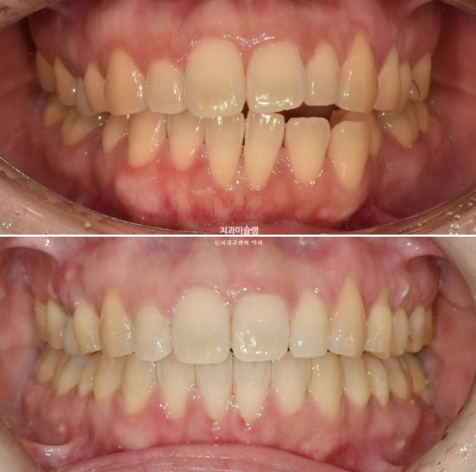 비발치 인비절라인 교정 편측 개방교합 가위교합 돌출 재교정 관련 이미지 19