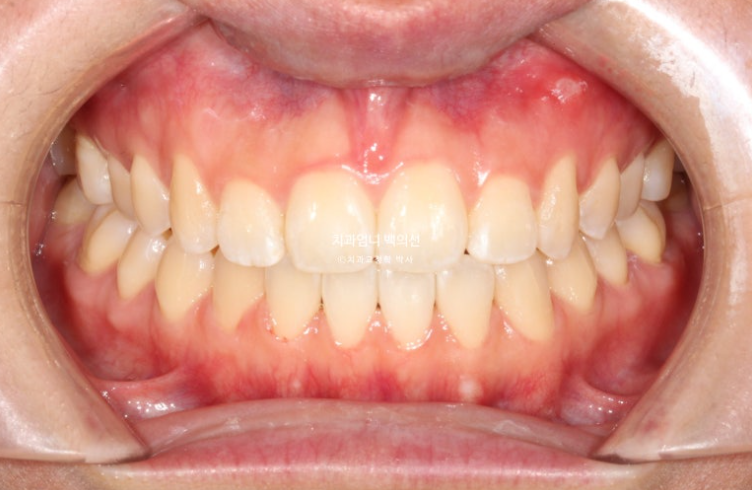 앞니 단기 부분교정 재교정 개방교합 교정 후기 관련 이미지 8