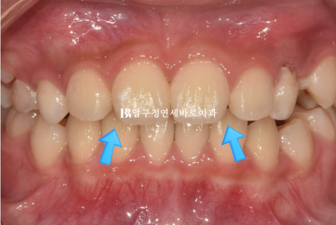 인비절라인 퍼스트 18개월 보증기간, 재제작이 필요한 이유는? 관련 이미지 13