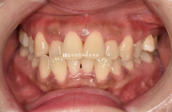 Is compliance important for Invisalign? | A real case that improved reverse bite and scissors bite in 8 months image 2