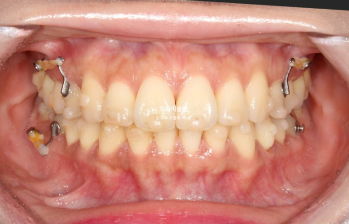 비발치 돌출입 인비절라인 교정 가위교합 중심선 맞추기 관련 이미지 14