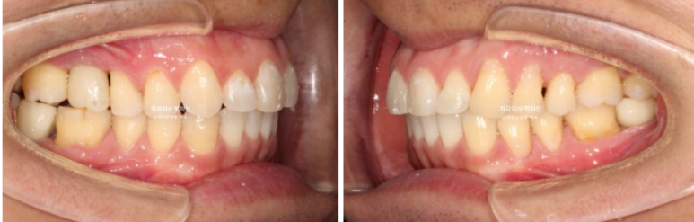 40대 인비절라인 라이트 과개교합 과잉치 덧니 교정 임플란트 보철 교정 후기 관련 이미지 17