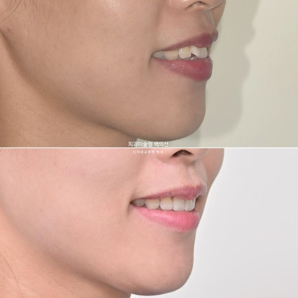 인비절라인 돌출입 발치교정 임플란트 없이 사랑니 대체 관련 이미지 1