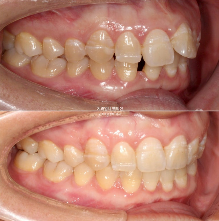 30대 교정 돌출입 교정 덧니 발치교정 치료기간 1년 8개월 관련 이미지 13