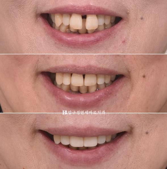 60대 치아교정 가능할까요? 치주염이 있는 경우 앞니 부분교정 6개월 치료 후기 관련 이미지 11