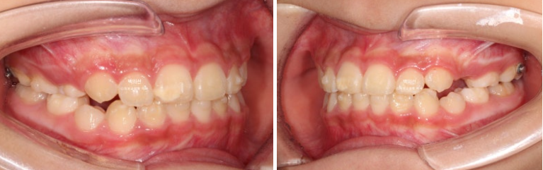 소아 비대칭 교정 인비절라인 퍼스트 재제작 1회 MA 치료 관련 이미지 12