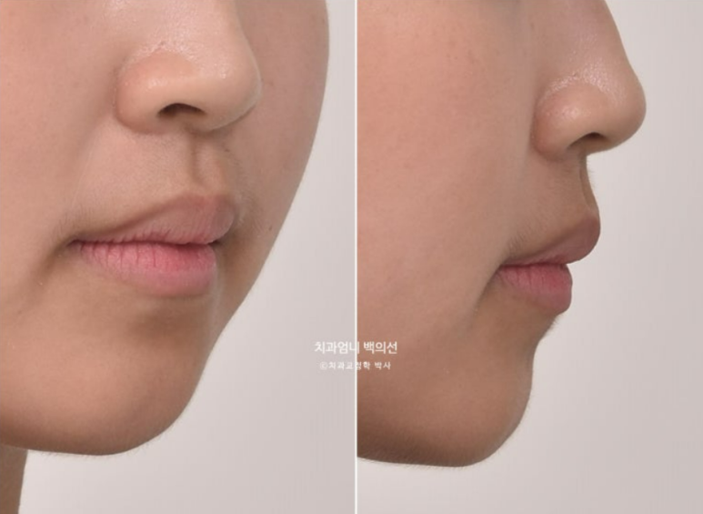 인비절라인 개방교합 교정 어금니 함입 교정 비베라? 관련 이미지 2