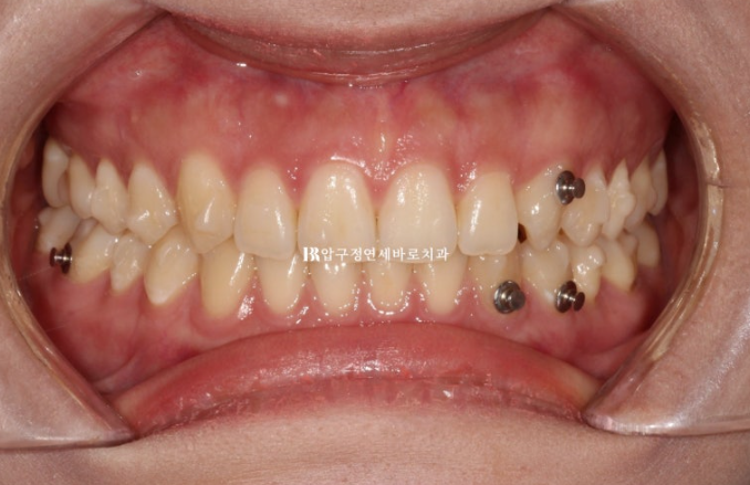 압구정 교정치과 / 옥니교정 인비절라인 라이트 덧니교정 관련 이미지 6