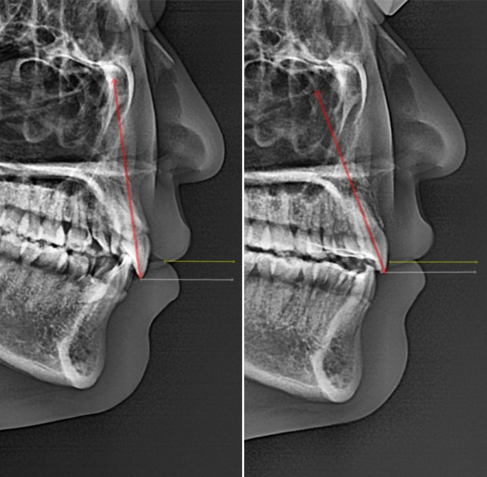 잇몸미소 거미스마일 치료 옥니 교정 잇몸성형 후기 관련 이미지 23