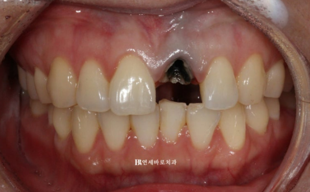 임플란트 없이 자연치아 살리기 앞니 부분교정 보철교정 관련 이미지 1