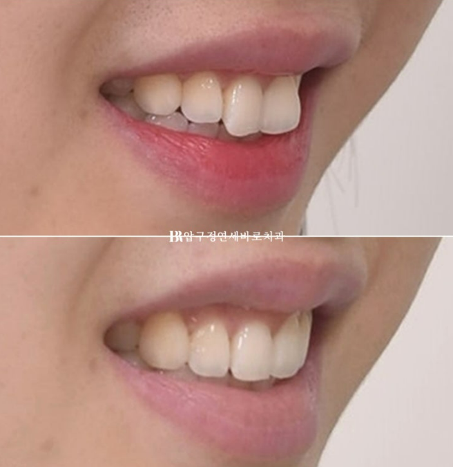 Can Rabbit Teeth Be Corrected? 5-Month Real Case of Butterfly Teeth Anterior Partial Orthodontic Treatment image 10