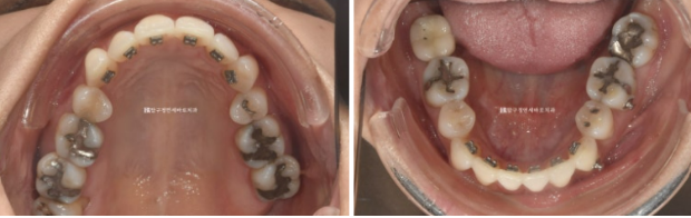 블랙트라이앵글 없애는 교정 가능할까요? 재교정 단기교정 후기 관련 이미지 4
