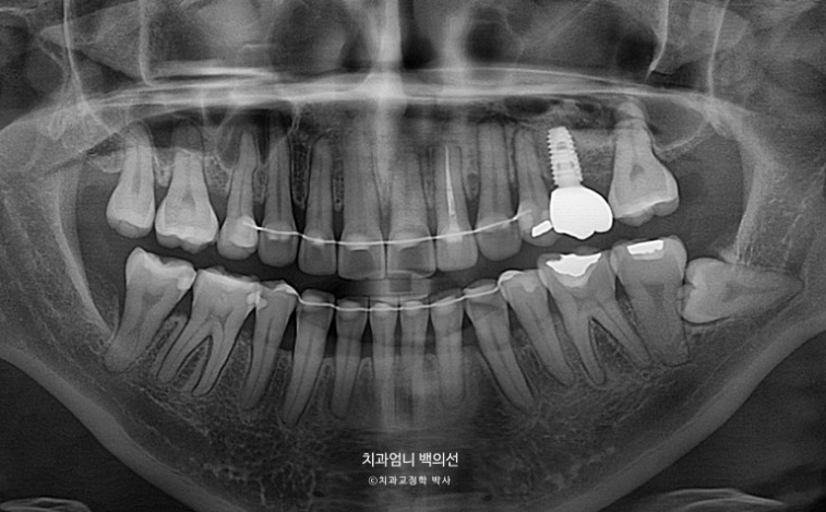 옥니 교정 역교정 재교정 무턱교정 치료기간 1년 10개월 관련 이미지 21