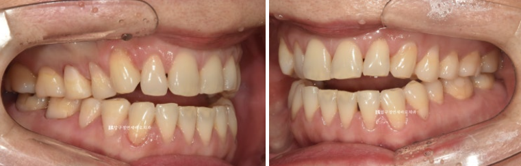 50대 인비절라인 개방교합 합입교정 미니스크류 관련 이미지 3