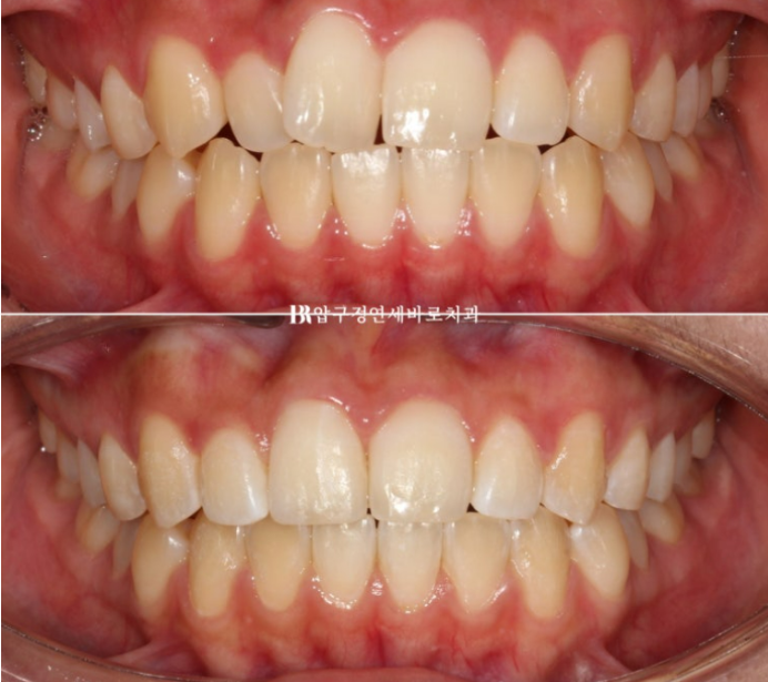 압구정 교정치과 덧니 부분교정 단기교정 후기 관련 이미지 1