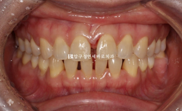 Can Gaps Between the Front Teeth Be Treated with No-Prep Veneers Alone? A Real Case Completed with Gelami After Invisalign Lite image 4