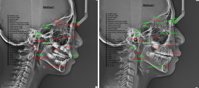 어린이 무턱 성장교정 덧니 인비절라인 퍼스트 악궁확장 치료기간 2년 관련 이미지 31