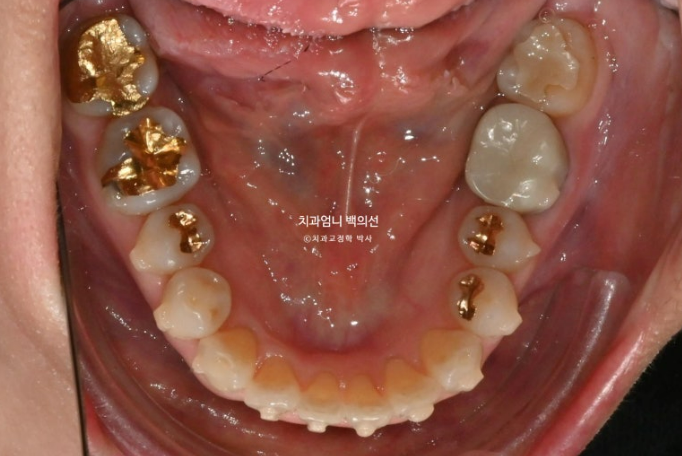 50대 치아교정 교합평면 기울어짐 토끼이 덧니 교정? 관련 이미지 7