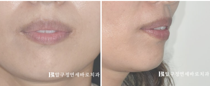 40대 돌출입 재교정, 입술부전증과 호두턱을 개선한 함입교정 증례 관련 이미지 2