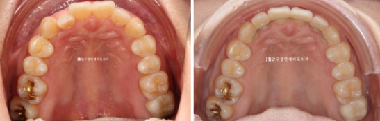 토끼이빨 치아교정 ? 토끼이빨 교정 치료기간은 어떻게 되나요? 관련 이미지 6