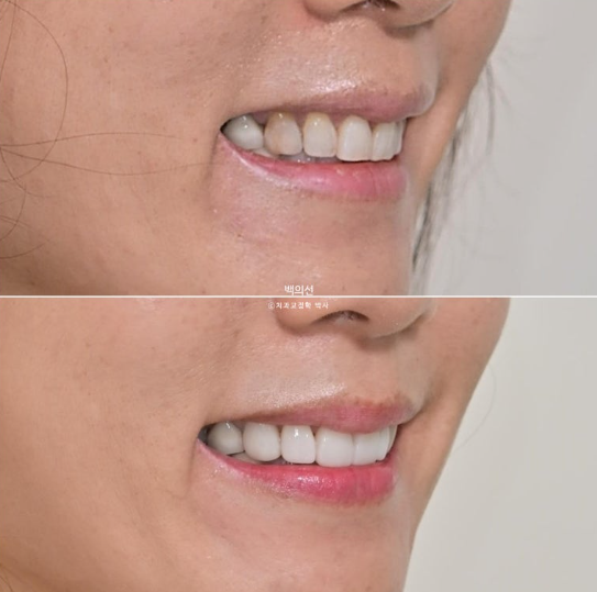 40대 무삭제 라미네이트 블랙트라이앵글 레진 치료 관련 이미지 12