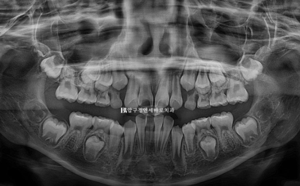 압구정 어린이교정 인비절라인 퍼스트 악궁확장 덧니 교정 관련 이미지 3