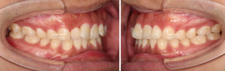앞니 부분교정 덧니 교정 블랙트라이앵글 부정교합 마모 시뮬레이션 치료기간 5개월 관련 이미지 3