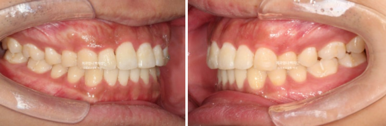 앞니 부분교정 덧니 교정 블랙트라이앵글 부정교합 마모 시뮬레이션 치료기간 5개월 관련 이미지 12
