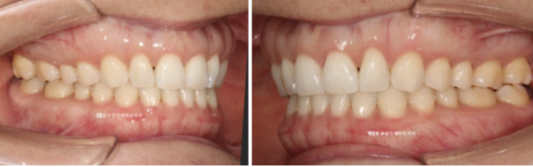 인비절라인 라이트 가위교합 치아 벌어짐 치료 관련 이미지 9