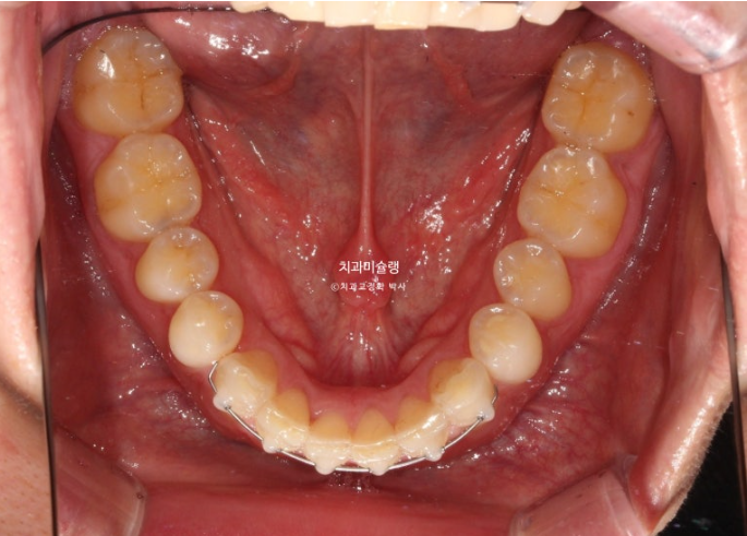 덧니 앞니 부분교정 급속교정 단기 MTA 미니튜브 기간 6개월 관련 이미지 8