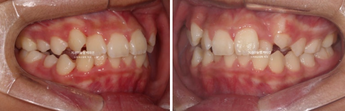 덧니 반대교합 과개교합 인비절라인 퍼스트 악궁확장 어린이 교정 관련 이미지 3