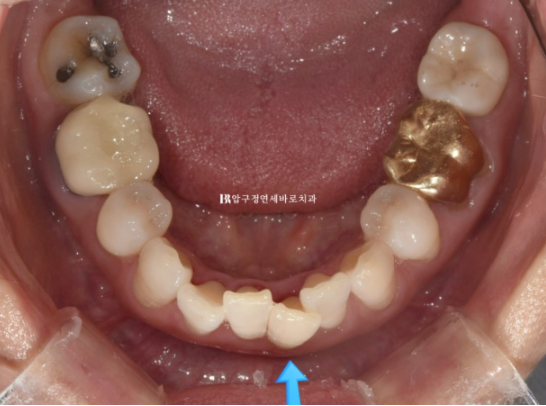 50대 중년교정 인비절라인 라이트 나비치아 교정 앞니 교정 후기 관련 이미지 4