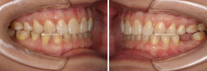 벌어진 치아 교정 인비절라인 라이트 무삭제 라미네이트 치료 관련 이미지 12