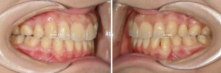 30대 인비절라인 덧니 발치교정 개방교합 치료 관련 이미지 18