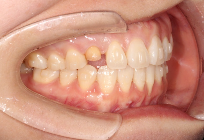 매복 결손 잔존유치 라미네이트 크라운 캔팅 인비절라인 라이트 치료 관련 이미지 14