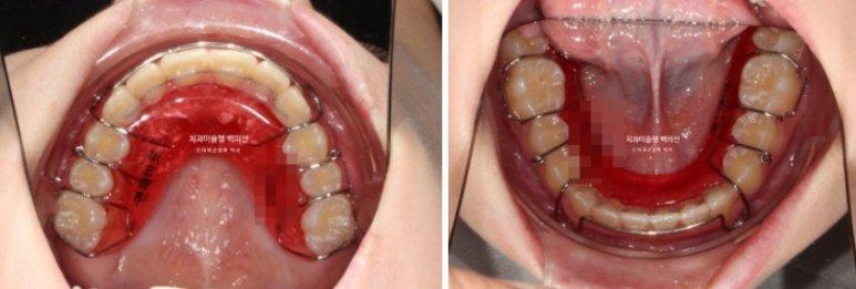 어린이 무턱 성장교정 덧니 인비절라인 퍼스트 악궁확장 치료기간 2년 관련 이미지 27