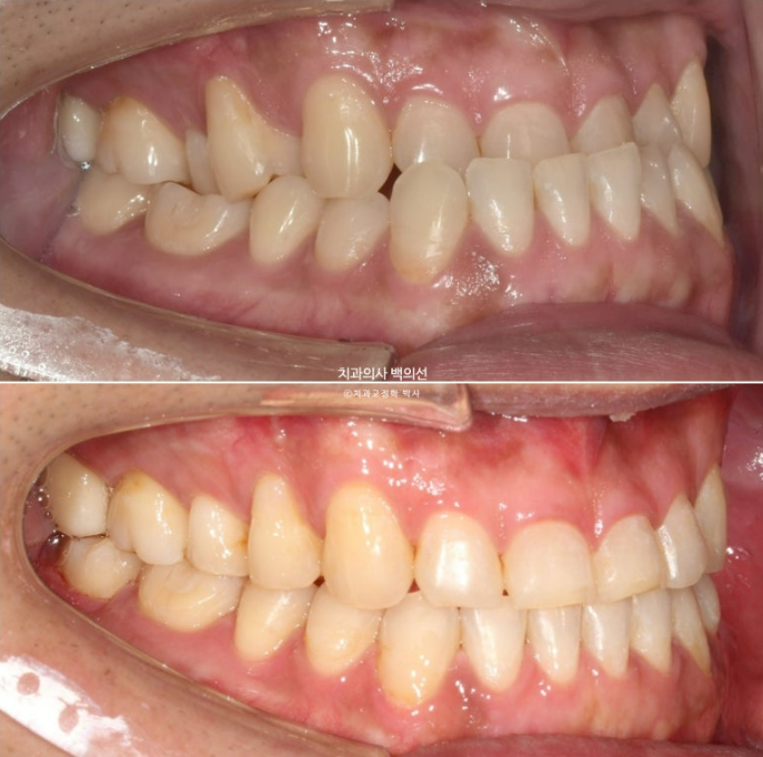 30대 주걱턱 비수술 비발치 교정 후기 관련 이미지 14