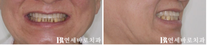 무삭제 라미네이트 하러 왔다가 부분교정을 먼저 한 이유 관련 이미지 7