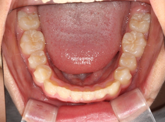 덧니 반대교합 과개교합 인비절라인 퍼스트 악궁확장 어린이 교정 치료 관련 이미지 17