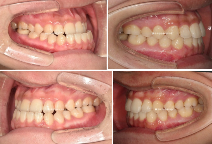양악수술 교정 인비절라인 주걱턱 교정 치료 후기 관련 이미지 10