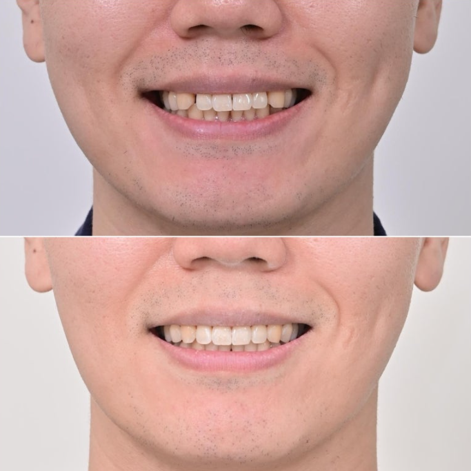 가위교합 벌어짐 중심선 과개교합 인비절라인 라이트 교정 관련 이미지 19