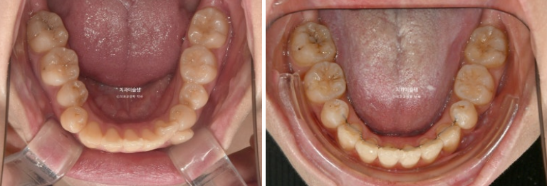 30대 인비절라인 덧니 발치교정 개방교합 치료 관련 이미지 20