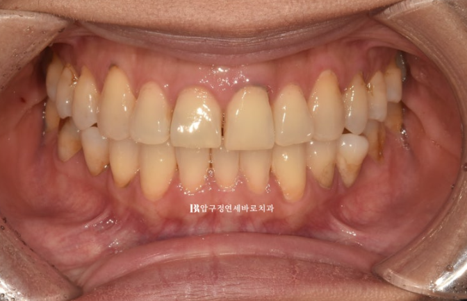 How to Avoid Regretting No-Prep Laminate Veneers: The Fitting Process Revealed image 1