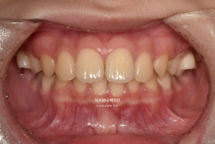 어린이 투명교정 인비절라인 퍼스트 가위교합 돌출교정 덧니교정 관련 이미지 2