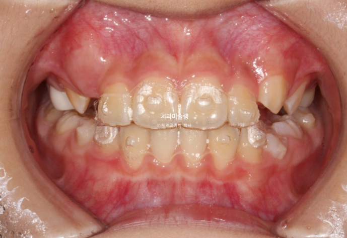 어린이 돌출입 교정 무턱 투명교정 인비절라인 퍼스트 관련 이미지 13