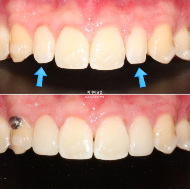 비대칭 비발치 거미스마일 잇몸미소 중심선 가위교합치료 무삭제 라미네이트 관련 이미지 19