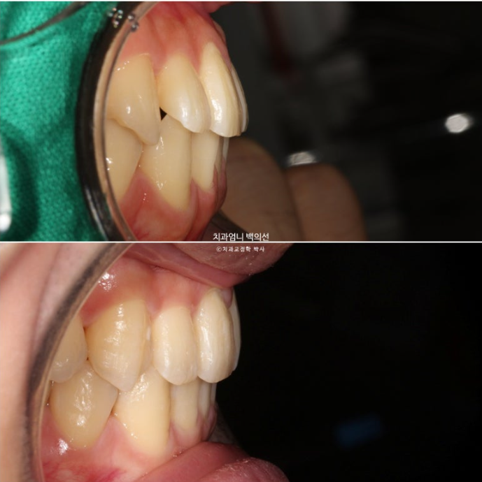 인비절라인 비발치 앞니 돌출 덧니 교정 ? 관련 이미지 18